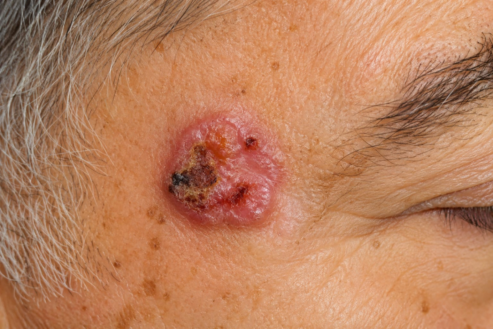 Cáncer de Piel | Dermatología Quirúrgica