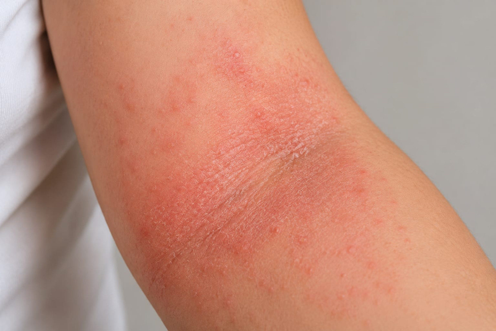 Dermatitis | Dermatología Clínica