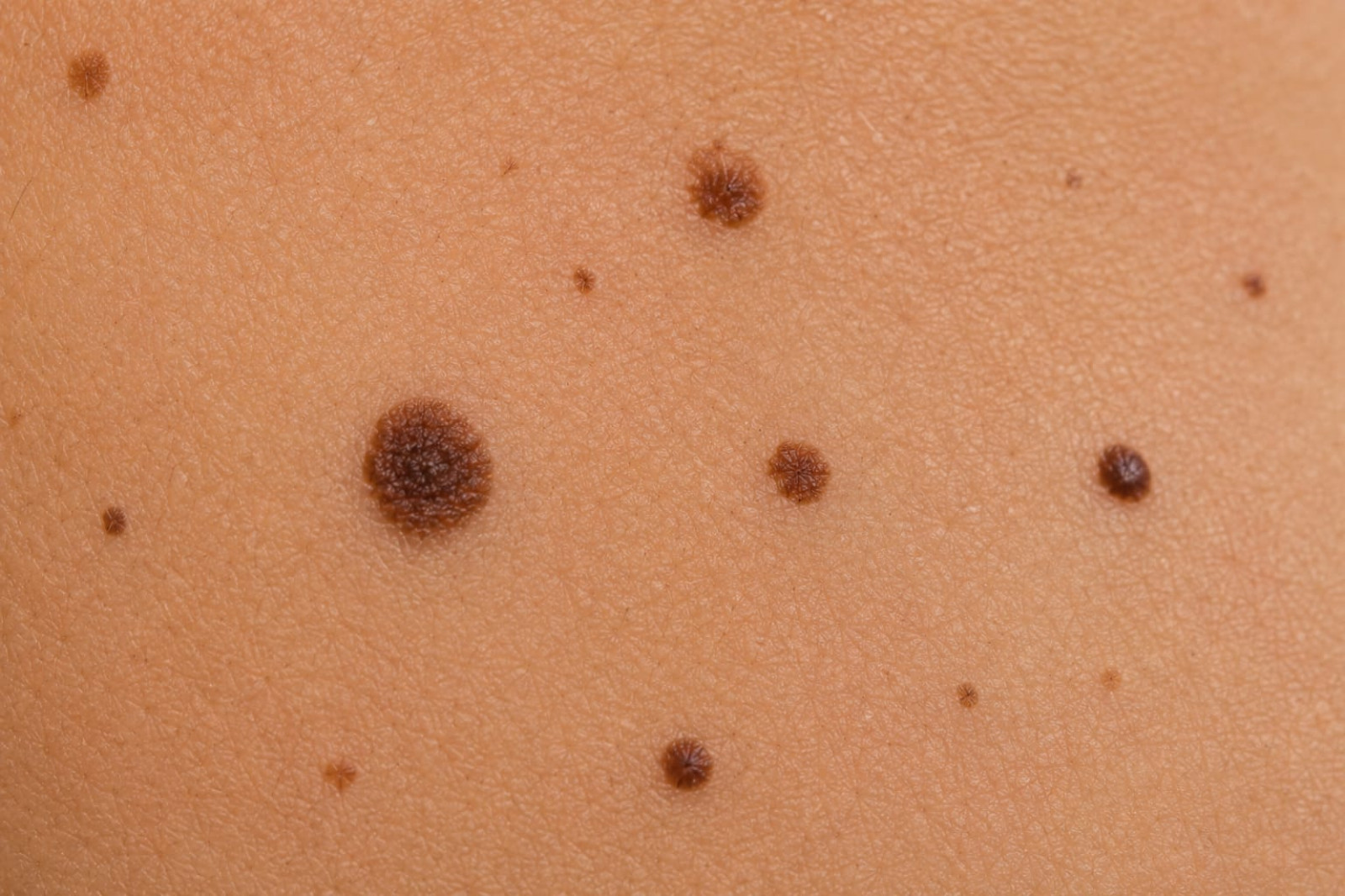 Lunares | Dermatología Quirúrgica