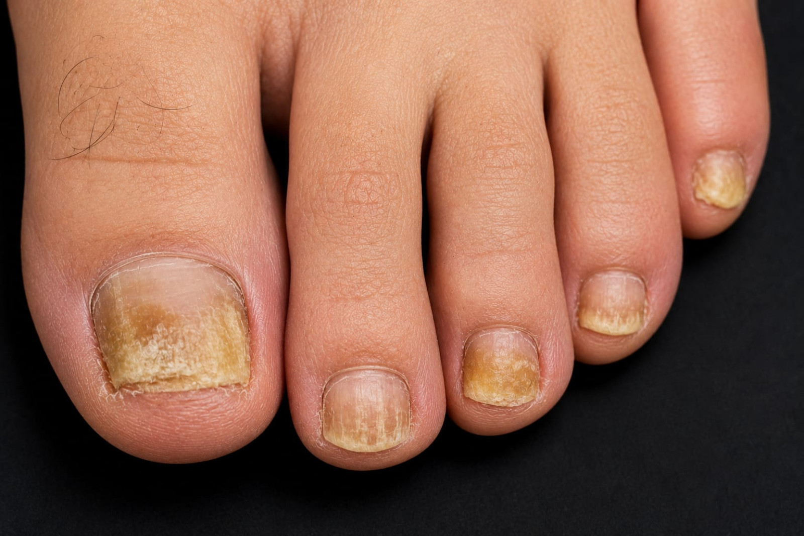 Onicomicosis | Dermatología Clínica