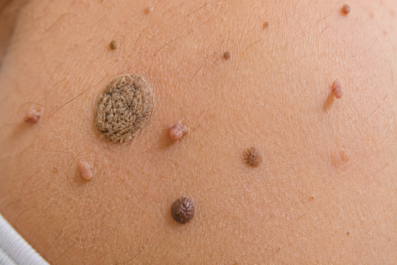 Tumores Benignos de Piel | Dermatología Quirúrgica